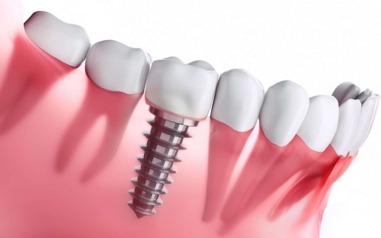 Implant dentaire : Un implant merveilleux ?