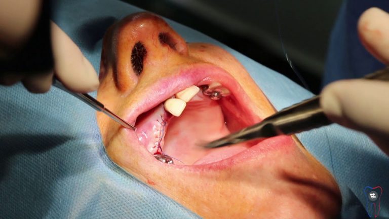 Implant dentaire : une dent remarquable ?